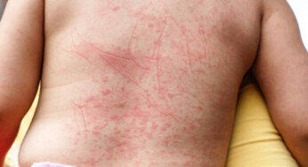 Saiba a diferença entre os sintomas da dengue e da gripe